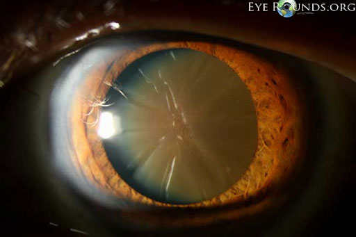 Mature cataract